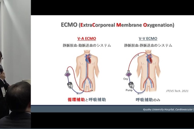 日本循環器学会学術集会のゲティンゲブースセミナで、V-A ECMOとV-V ECMOの説明をする医師