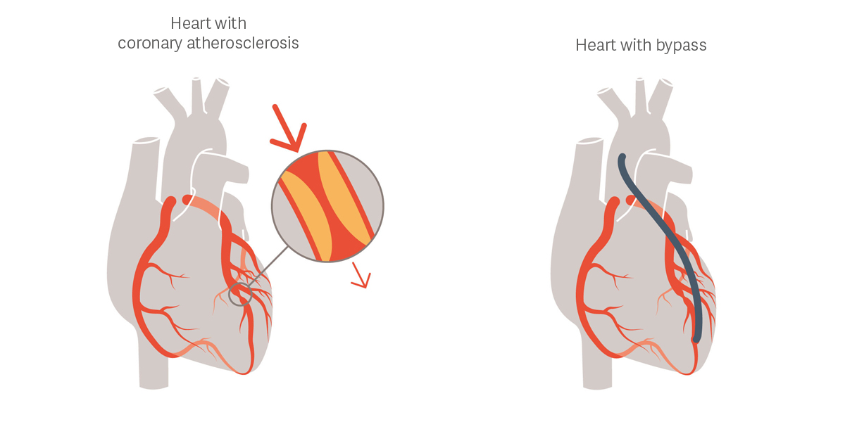 ww5 CABG illustration