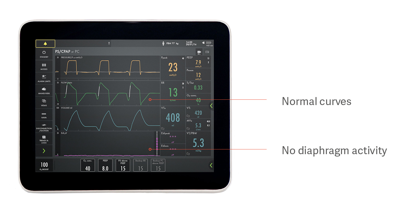 Triggering ventilator with no diaphragm activity