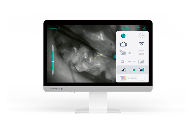 Presentation of quantification tool during parathyroid surgery