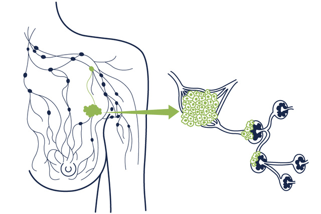 Illustration of sentinel lymph node mapping using fluorescence imaging, showing tracer migration and targeted lymph node detection.