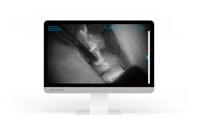  visualization of vascular assessment with ICG fluorescence imaging during parathyroid surgery