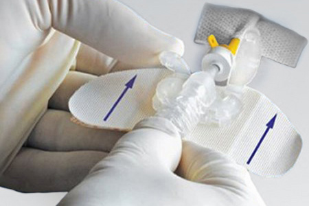 Gloved hands adjusting a medical device with adhesive wings and a yellow connector.