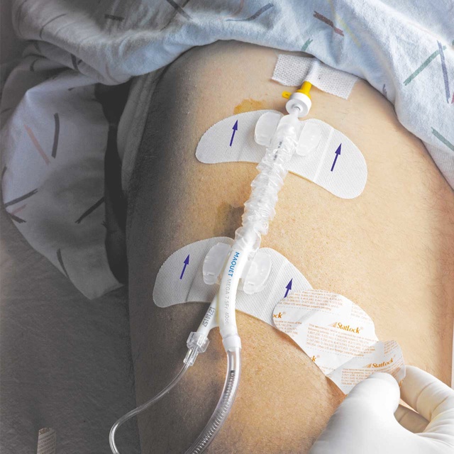 Medical drain tube secured on a patient’s abdomen with adhesive bandages.