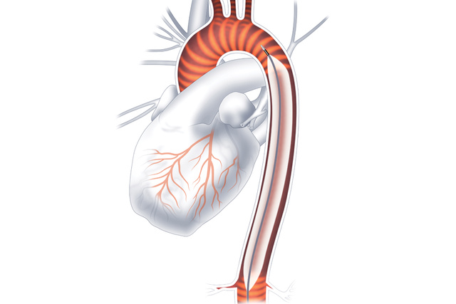 Graphic illustration of large volume balloon used in IABC procedures, ww5 