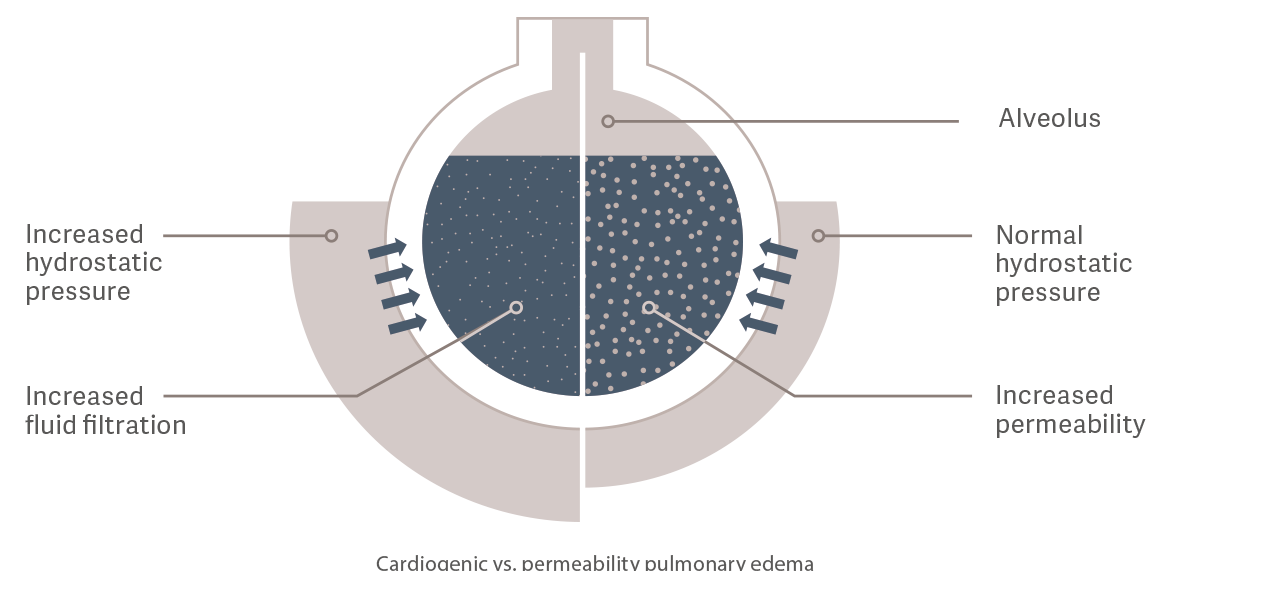 Cardiogenic vs. permeability pulmonary edema