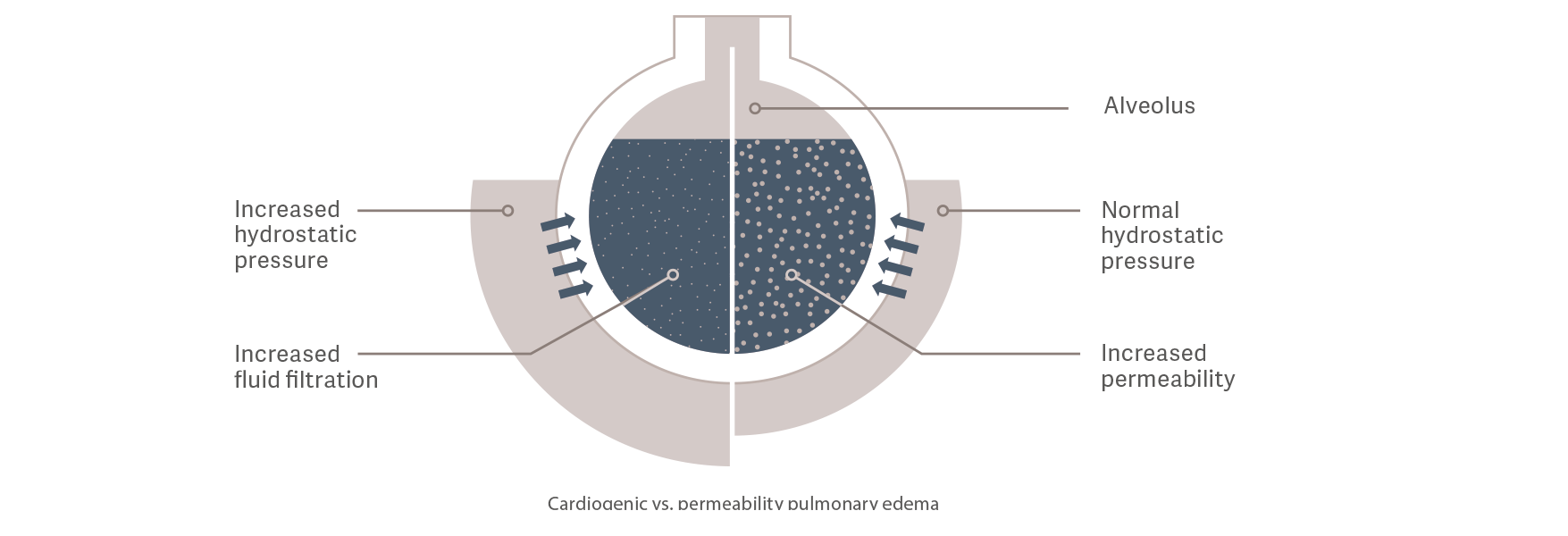 Cardiogenic vs. permeability pulmonary edema