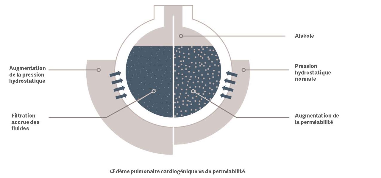 Schéma comparatif œdème pulmonaire cardiogénique et de perméabilité