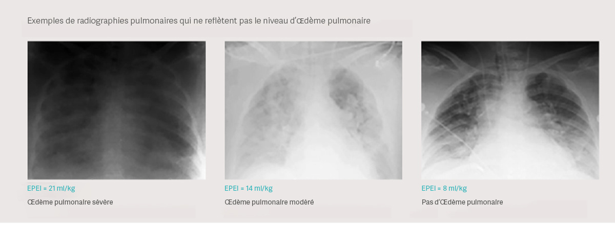 Trois radiographies pulmonaires montrant différents degrés d’œdème pulmonaire : sévère, modéré et aucun. .