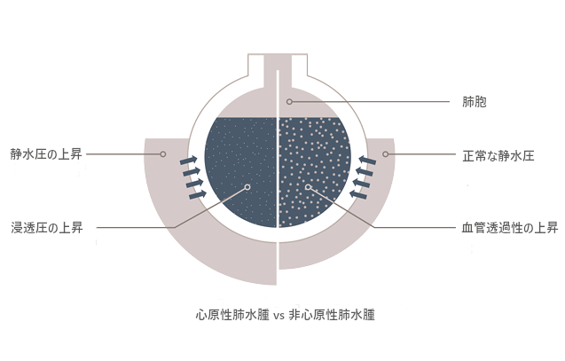 心原生肺水腫vs非心原生肺水腫の図