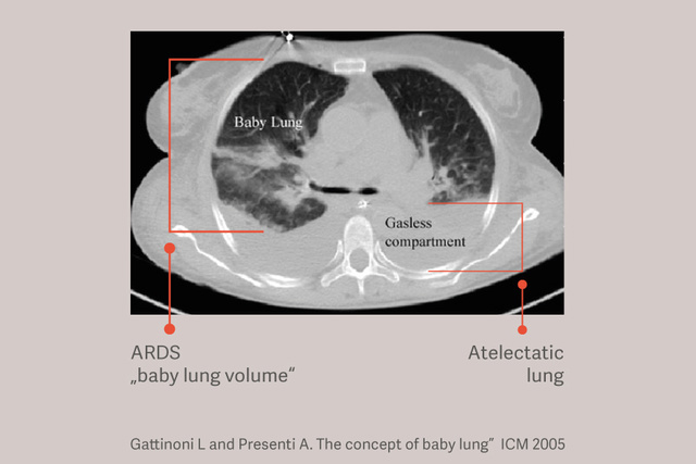 Gattinoni L and Presenti A. The concept of baby lung”  ICM 2005
