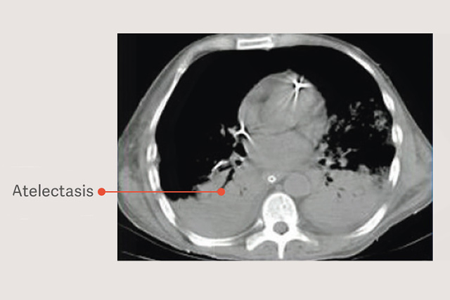Atelectasis lung