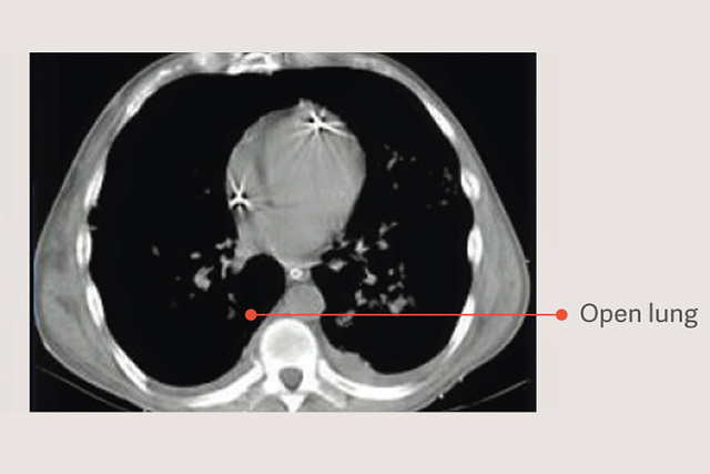 Open lung
