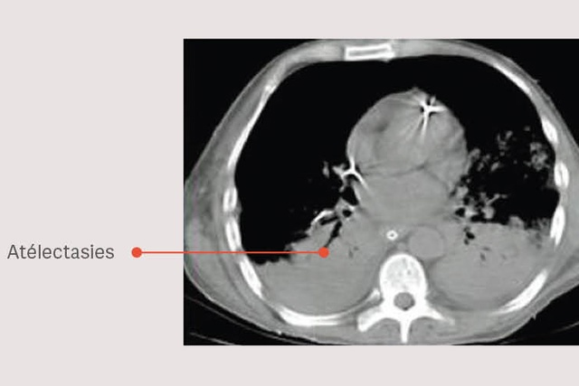Scanner thoracique qui montrant une atélectasie avec une flèche étiquetée pointant vers la zone pulmonaire affectée .