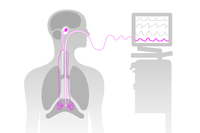 Illustration d'un Servo-u surveillant l'activité pulmonaire à l'aide de sonde