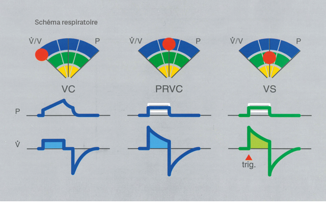 Diagramme comparant les formes d'onde respiratoires : VC, PRVC et VS, avec des graphiques de pression et de volume et des cycles à code couleur.