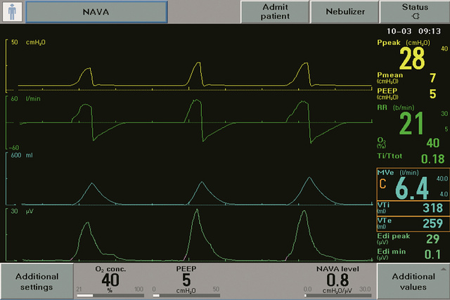 ww5 Neurally Adjusted Ventilatory Assist NAVA screen showing Edi signal the vital sign