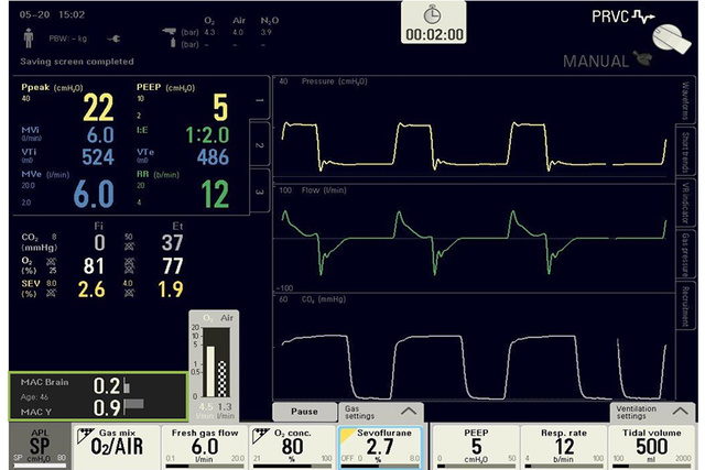MAC Brain Flow Family anesthesia